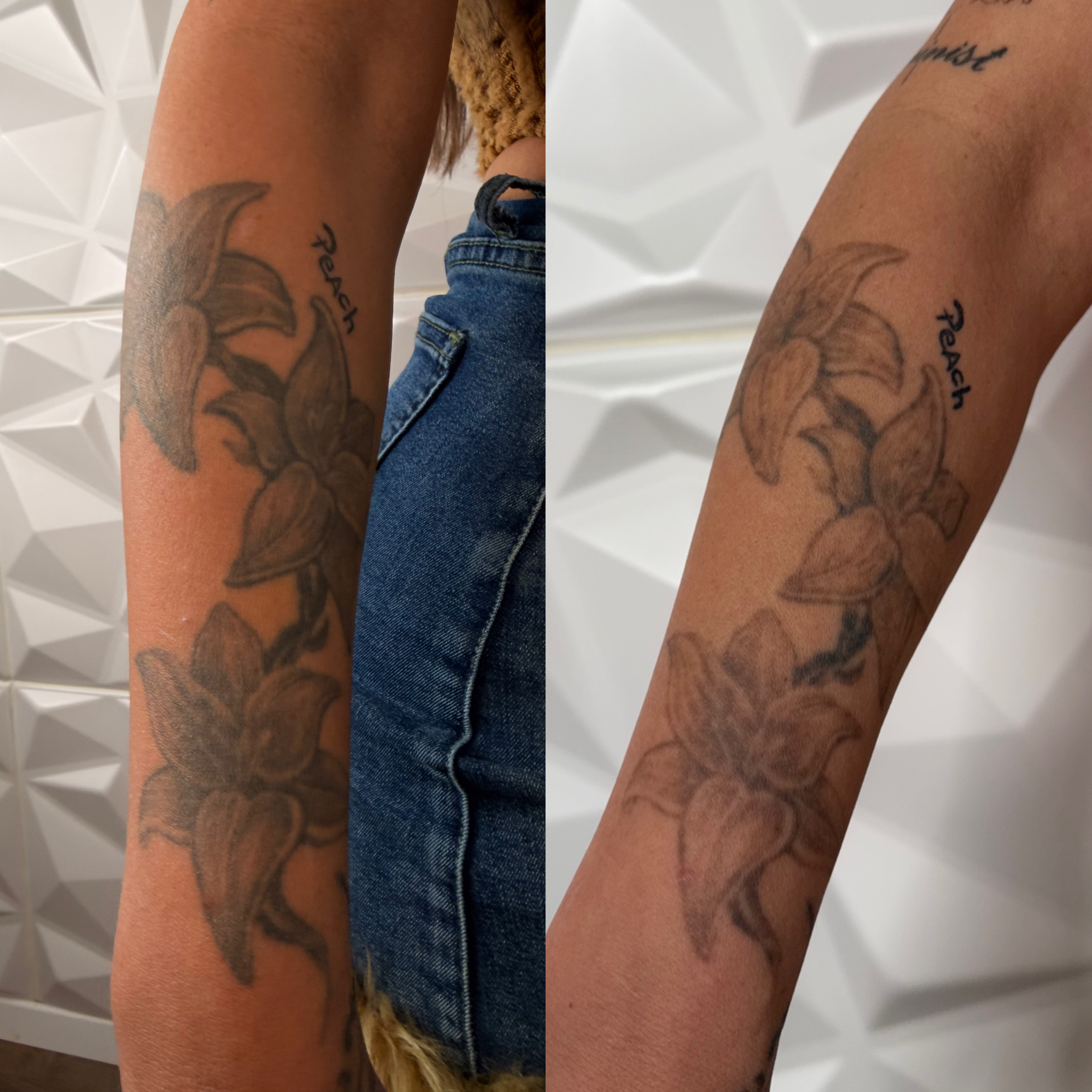 Vorher/Nachher Ergebnis 2